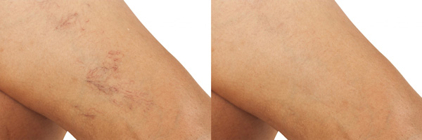 Hautbehandlungen mit Laser Hautbehandlungen mit Laser