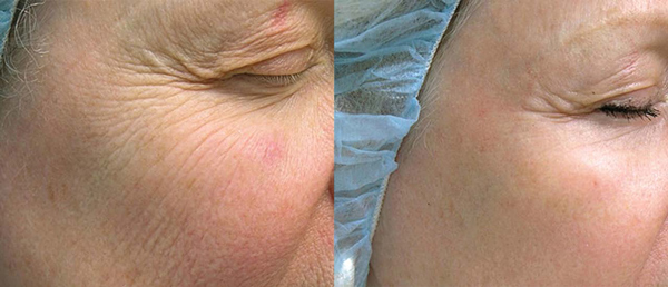 Hautbehandlungen mit Laser Hautbehandlungen mit Laser