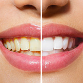 Kosmetisch Zähne aufhellen / bleichen